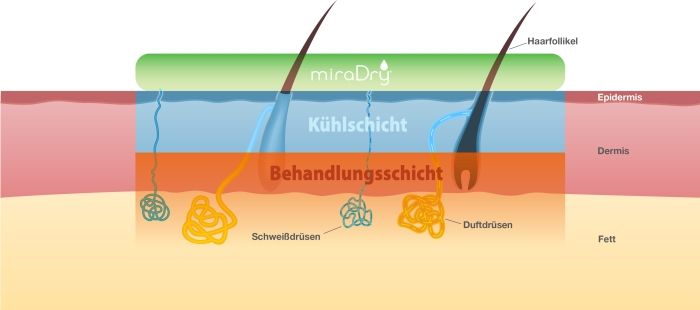 Hautschichten welche bei der MiraDry Therapie behandelt werden